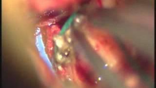Trans sulcal Approach for Resection of an Atrial Meningioma