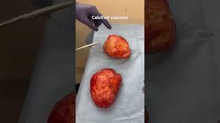 Calcified implant capsules #breastimplantillness #health #oddlysatisfying #asmr