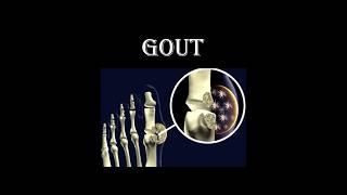 What Is Gout? The Silent Joint Attacker! #Gout #Arthritis #HealthFacts #JointPain #Shorts