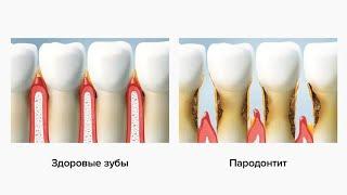 ПАРОДОНТИТ И ПАРОДОНТОЗ: В ЧЁМ РАЗНИЦА?