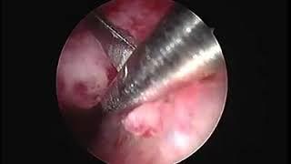 Hystroscopic polypectomy without anaethesia by Dr/ waleed almery
