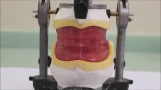 Fabrication of Occlusion rims