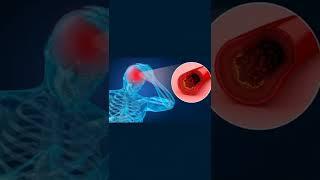 Thrombectomy - for stroke treatment | Apollo Hospitals Ahmedabad | Dr. Mukesh Sharma