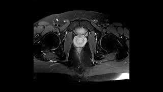 Normal and abnormal prostate gland on 3 patients with MRI hips