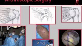 Rotator Cuff Tear: Diagnosis & Treatment