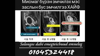Хоргүй хавдар миома-г мэс заслын бус аргаар  эмчилэх Хайф төв