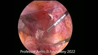 Laparoscopic Hysterectomy and Colposacropexy