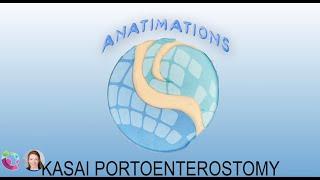 Kasai Portoenterostomy Anatimation