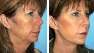 Facelift Surgery in Seattle Washington - Dr William Portuese