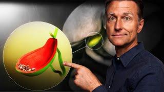 Gallbladder Removal (Surgery) - Vital Things to Know: MUST WATCH