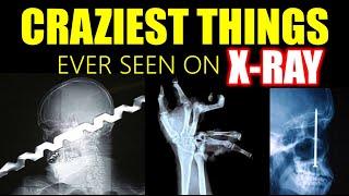 Craziest Things Ever Seen on X Rays!  #xray #doctor #science