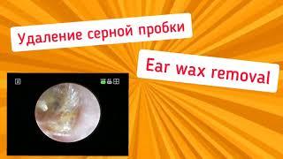 Ear wax removal. Удаление серной пробки.