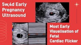 Most early Fetal Cardiac Flicker Visualization - 5.5wks | Ultrasound