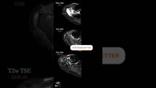 MRI SHOULDER – KNOW YOUR TECHNIQUES WELL PART 2