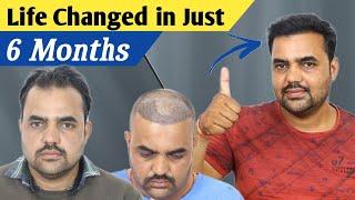 6 Months Best Hair Transplant Result  || Hair Transplant in mp