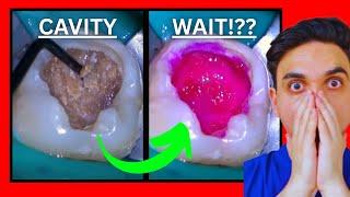 Dentist Reacts to VIRAL Tooth Decay DRILL & Fill
