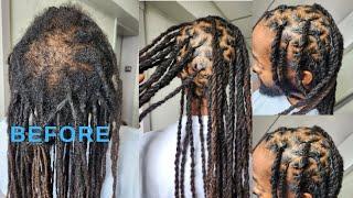 HOW TO: COOLEST LOC TRANSFORMATION //REPLACING BALD SPOTS WITH NATURAL LOCS