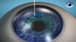 Femto LASIK mit LenSx Femtosekunden Laser - Augenlasern | AUGENKLINIK TEUFEN