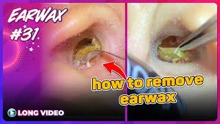 EP 31 Earwax ASMR. You Can Remove Earwax Yourself After Watching This Video