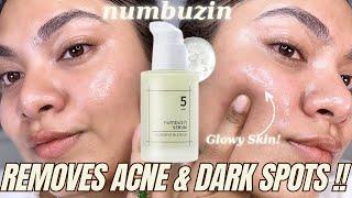 Best Brightening Serum! Tested Numbuzin No. 5 Goodbye Blemish Serum for Acne & Dark Spots #review