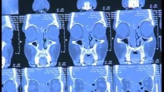 FESS Unedited ( Case 1 ) - Dr. Satish Jain - www.skullbase360.in ...