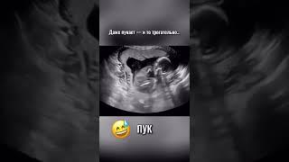 Даже это они делают еще в животике #акушергинеколог #прикол #пук #роды #родыдома #малыши