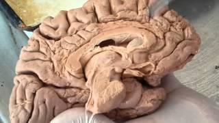 corpus callosum