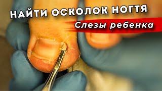 Плакал, но доверял. История вросшего ногтя у ребенка 10 лет #подология