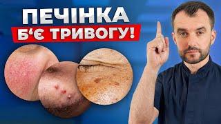 Перші ознаки проблем з печінкою! НЕ ІГНОРУЙ ЦІ СИГНАЛИ!