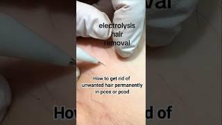 How to remove unwanted hair permanently ! best hair removal method #electrolysis #pcos #shorts #fyp