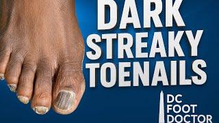 Dark Streaky Toenails