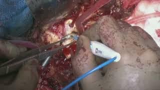 Thoracoabdominal aortic replacement with removing stent graft against huge aortic aneurysm