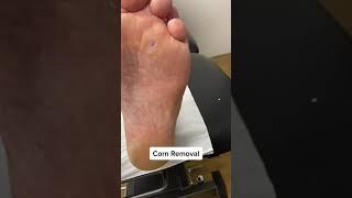 Callus and Corn Removal by Podiatrist | Latest Techniques with Ergonx and Docpods