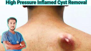 Infected Sebaceous Cyst Removal: Causes, Symptoms and Treatment Explained