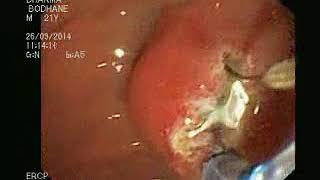 Pancreas divisum endotherapy  wmv