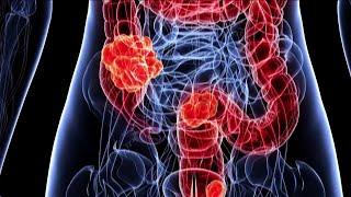 Cologuard vs colonoscopy: A question of convenience, money