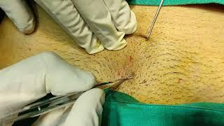 Pubic hair graft extraction for eyebrow Transplant