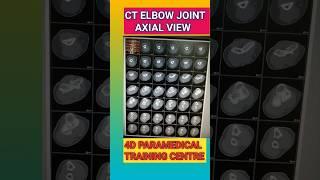 CT ELBOW JOINT FILMING #radiology #anatomy #jointpain #elbow #xray #radiographer #fracture