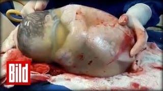 Baby in Fruchtblase geboren - Hammer Video