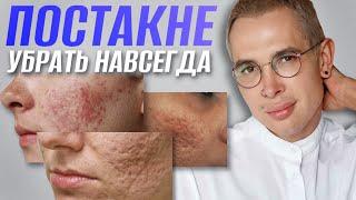 ПОСТАКНЕ как избавиться? Самый ПРАВИЛЬНЫЙ и ЭФФЕКТИВНЫЙ способ #постакне