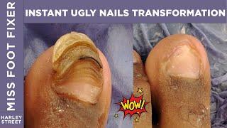 INSTANT UGLY NAIL Transformation By Miss Foot Fixer Marion Yau