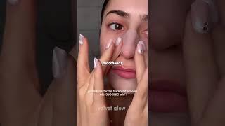 Goodbye blackheads — forever! 