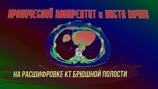 Жировой ГЕПАТОЗ печени, ПАНКРЕАТИТ хронический, КИСТА левой почки на РАСШИФРОВКЕ КТ брюшной полости