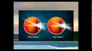 Orthokeratology in the News Jagrut Lallu explains