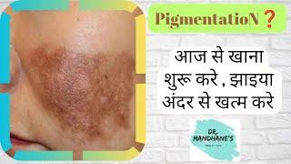 Zaiya/food for pigmentation removal झाइयां/वांग कम करने के‌ लिए क्या खाएं/dark spot on face