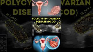 PCOD vs PCOS | क्या दोनों एक है ? जानिए दोनों में क्या Difference हैं ? #pcod #pcos #shorts