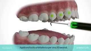 Applicazione Attachments - SMILETECH