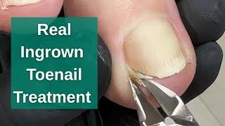 Real Ingrown Toenail Treatment | Full Step-by-Step #toenails