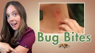 Get Rid of Bug Bites FAST and Stop the Itch