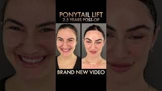 Feeling Like a Million Bucks! New Video Tomorrow | Ponytail Lift Results | Facelift Before & After